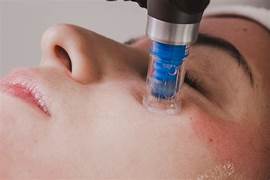 Microneedling